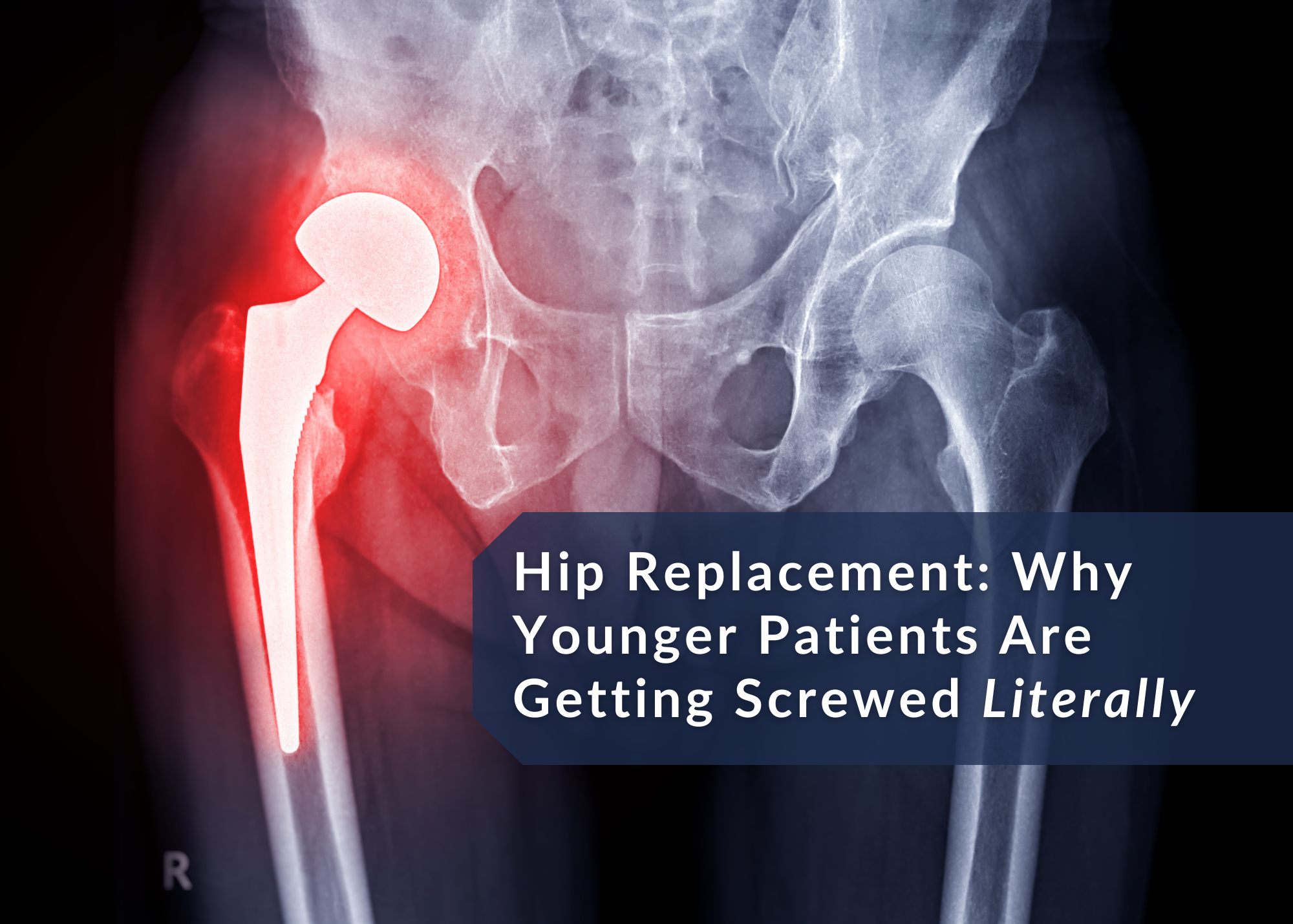 Hip Replacement: Why Younger Patients Are Getting Screwed (Literally)