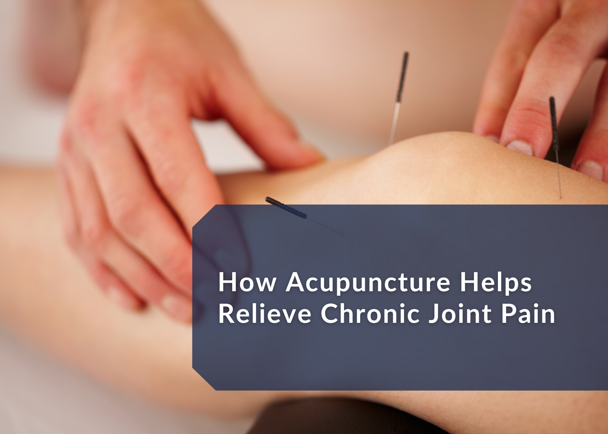 How Acupuncture Helps Relieve Chronic Pain, Naturally