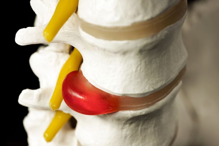 Find Freedom from Chronic Back Pain with Spinal Decompression